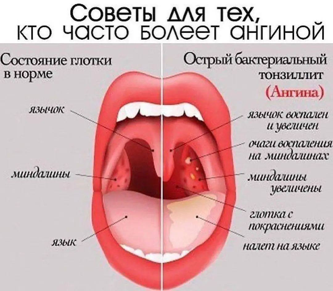 Обезболить горло при ангине ребенку. Острый катаральный тонзиллит. Ангина небных миндалин.