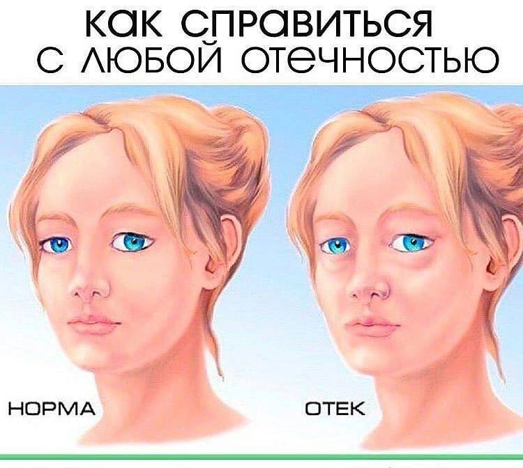 Как быстро снять сильные отеки