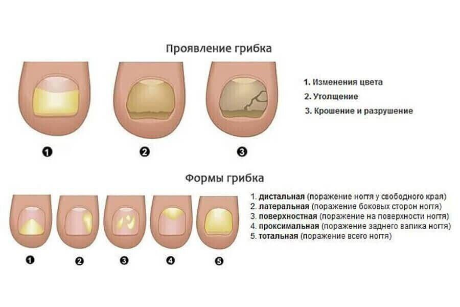 Грибок Кожи Разновидности Фото И Названия