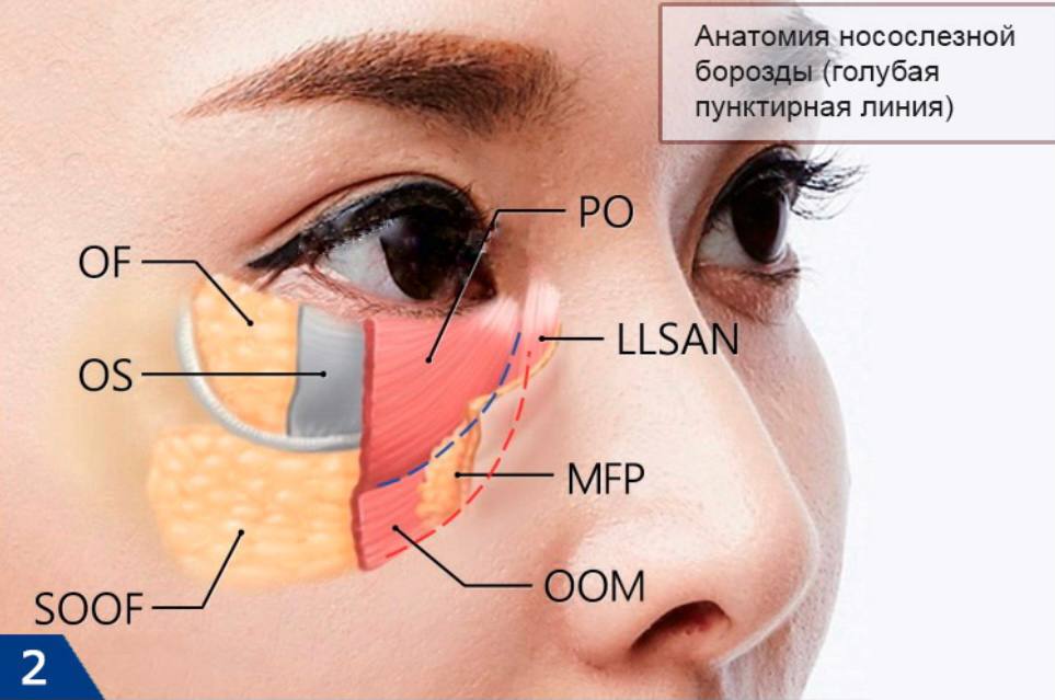 Среднещечная борозда. Малярный мешок слезная борозда. Носослезная борозда анатомия. Анатомия носослезной борозды. Носослезная борозда схема.